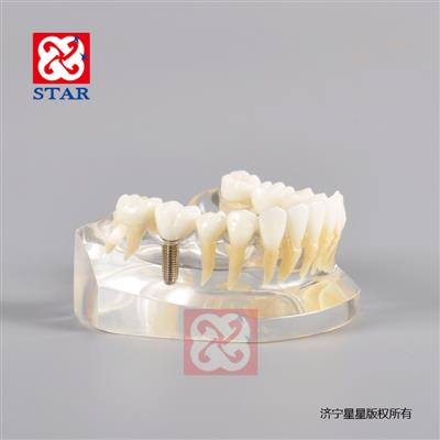 下颌种植M2010