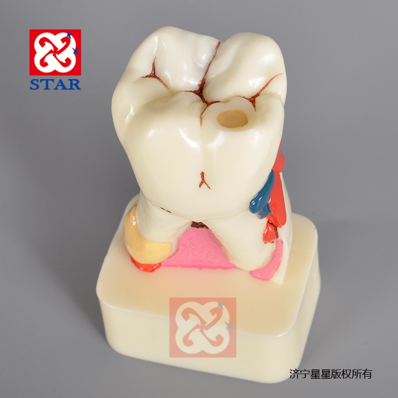四倍牙齿综合病模型M4015