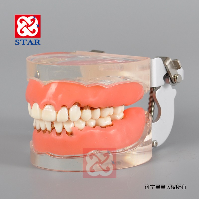 牙周病模型M4017